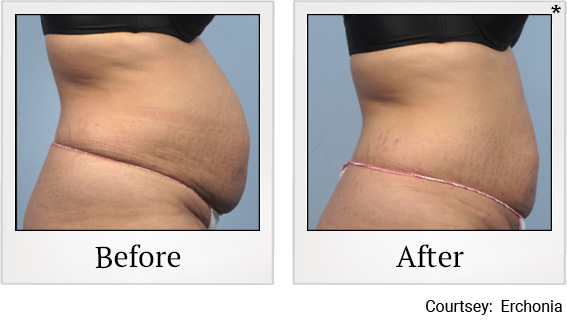 Before and After photos of Fat Reduction at Zerona Santa Rosa in Santa Rosa