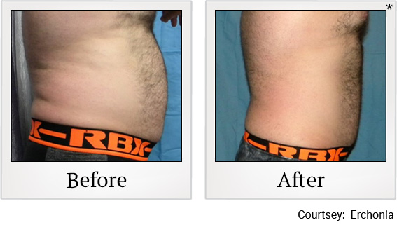 Before and After photos of Fat Reduction at Zerona Santa Rosa in Santa Rosa