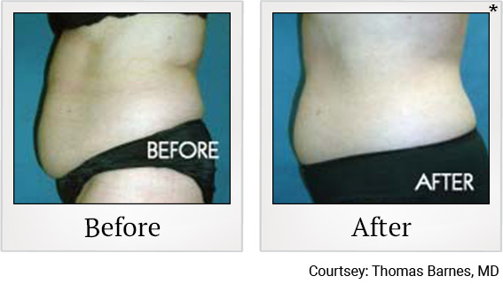 Before and After photos of Fat Reduction at Zerona Santa Rosa in Santa Rosa