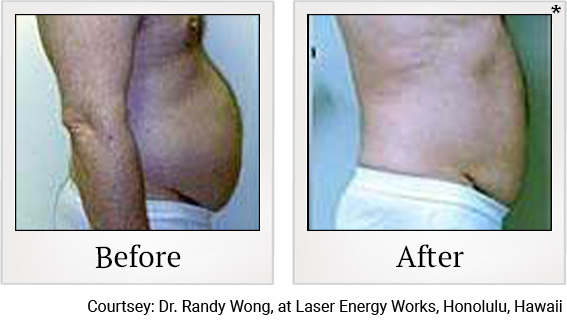 Before and After photos of Fat Reduction at Zerona Santa Rosa in Santa Rosa