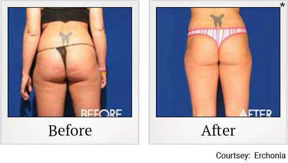 Before and After photos of Fat Reduction at Zerona Santa Rosa in Santa Rosa